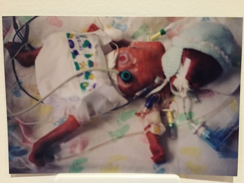 Andy as a 1lb 15oz premature baby in hospital.  He has tubes coming out of him and his nappy is far too big.