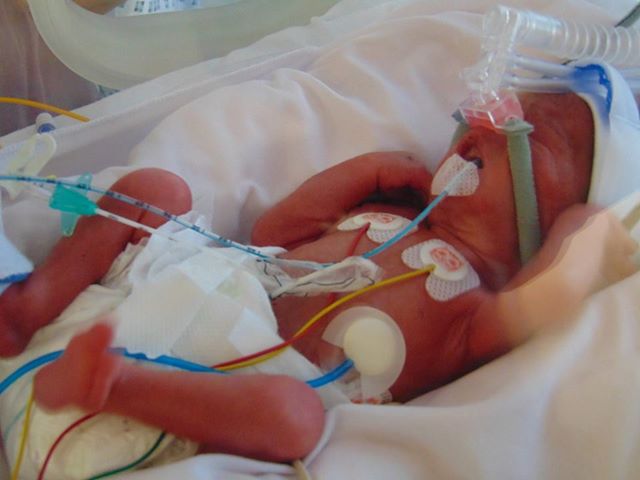 Wolfe as a tiny premature baby in an incubator, with tubes attached to him.