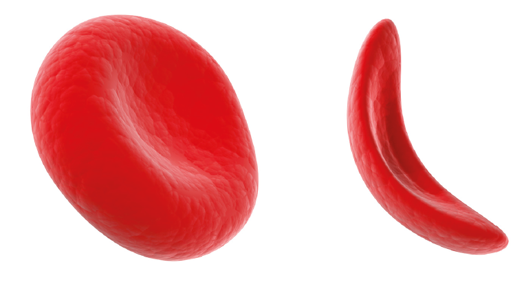 Normal round, plump, red blood cell on left and flat, thin, sickle cell on the right. 