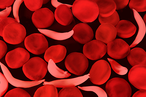 Image of disc shaped normal red blood cell alongside sickle shaped cell